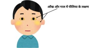jaundice-ayurvedic-treatment-in-hindi